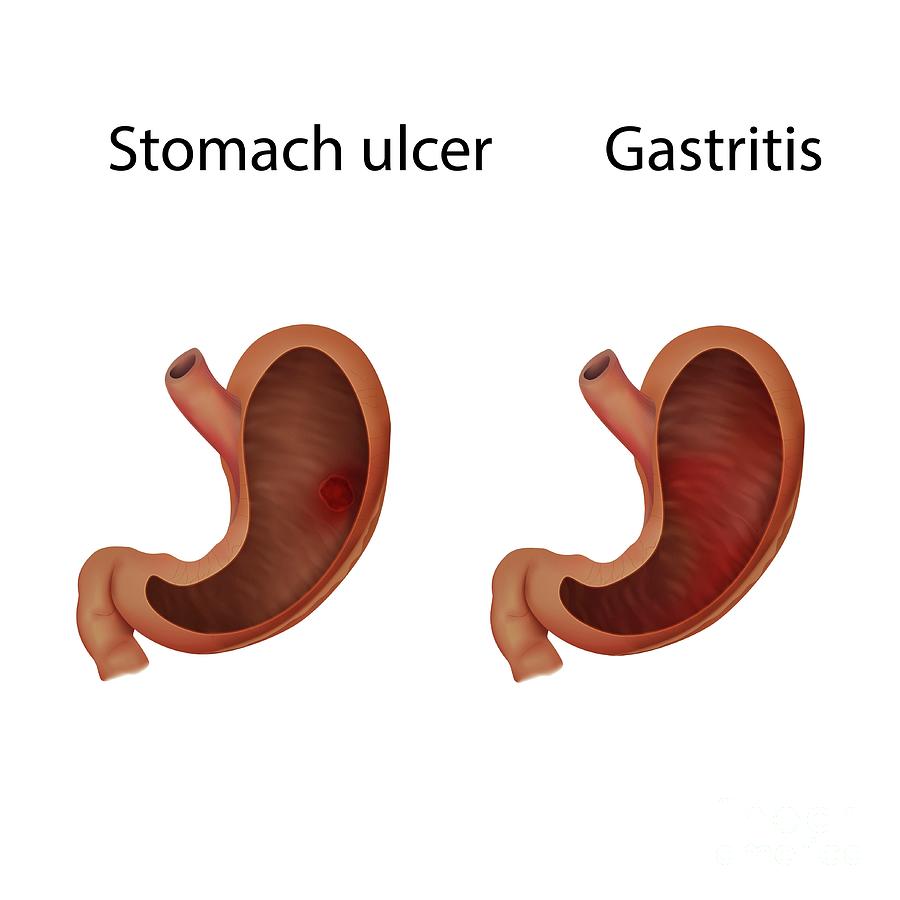 Gastritis And Stomach Ulcer Photograph by Veronika Zakharova/science ...