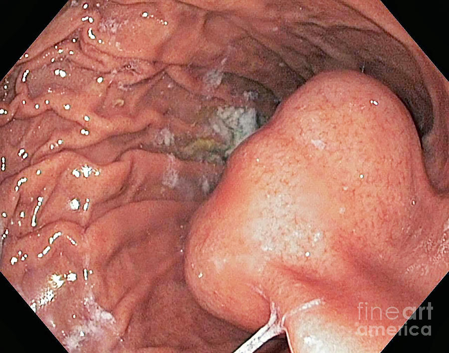 Gastrointestinal Stromal Tumour Photograph by Gastrolab/science Photo Library