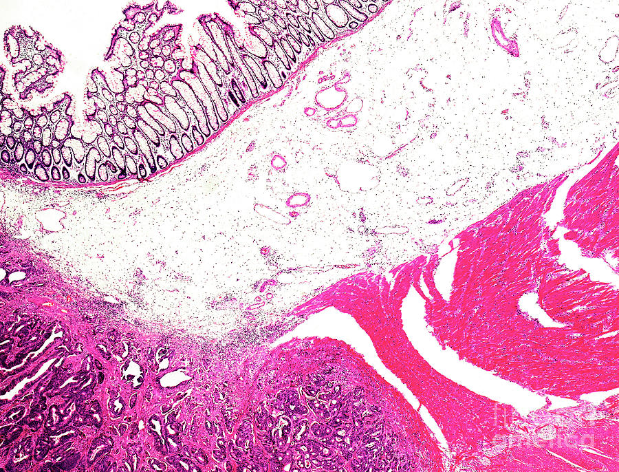 Gastrointestinal Stromal Tumour Photograph by Nigel Downer/science Photo Library