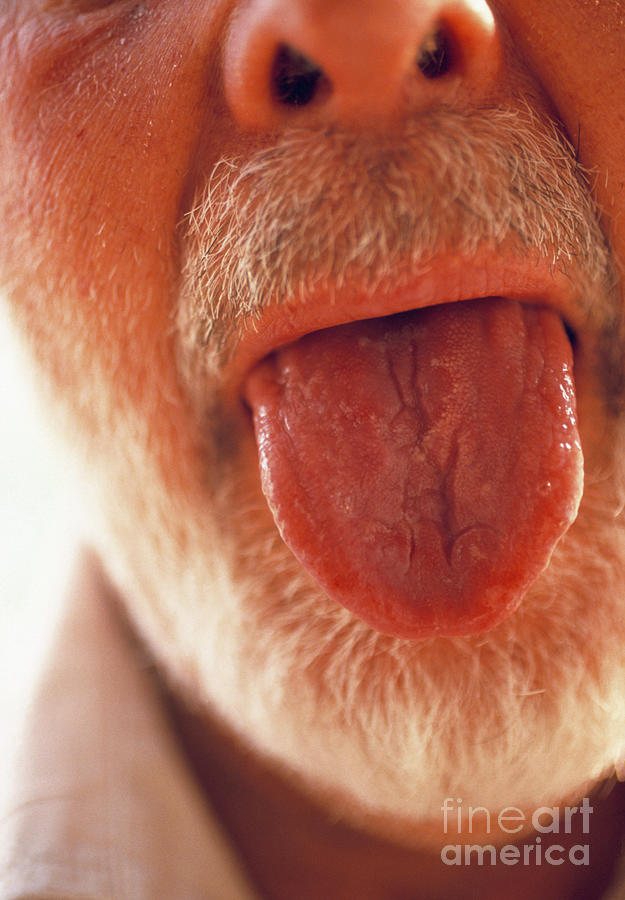 Geographic Tongue Photograph by John Howard/science Photo Library