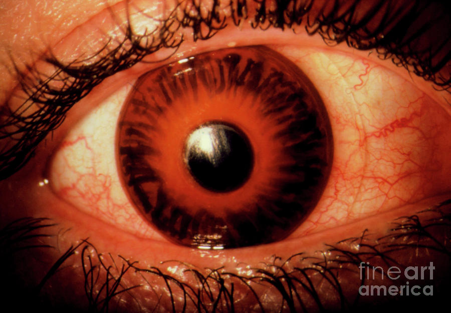 Glaucoma Swollen Inflamed Eye With Contact Lens Photograph By Western