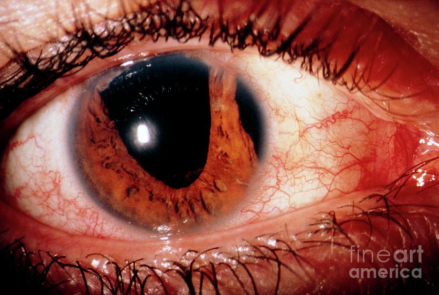 eye pupil swollen
