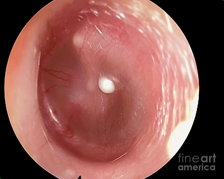 Glue Ear Photograph - Glue Ear And Dermoid Cyst by Professor Tony Wright, Institute Of Laryngology & Otology/science Photo Library