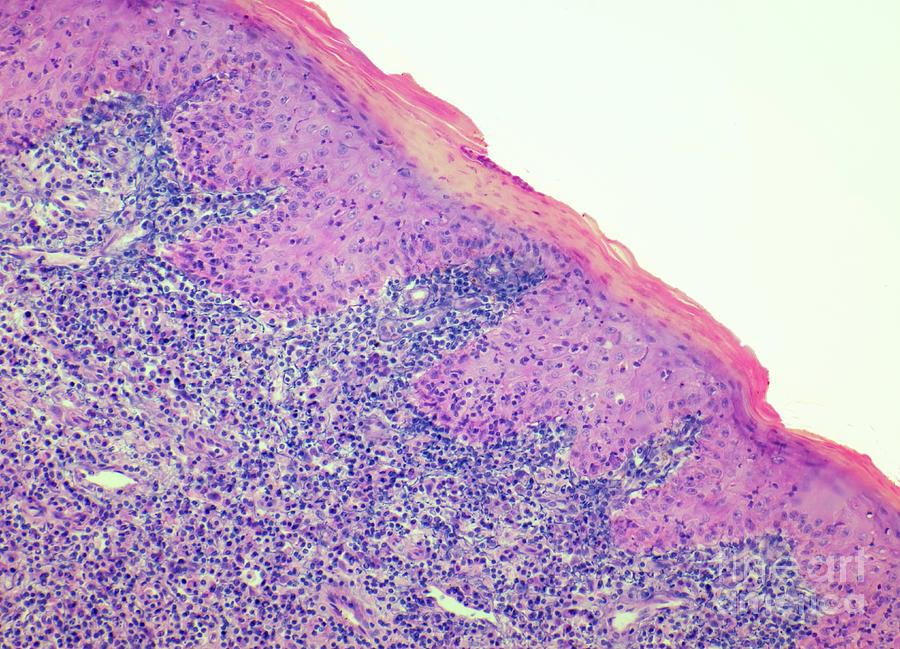 granulation tissue