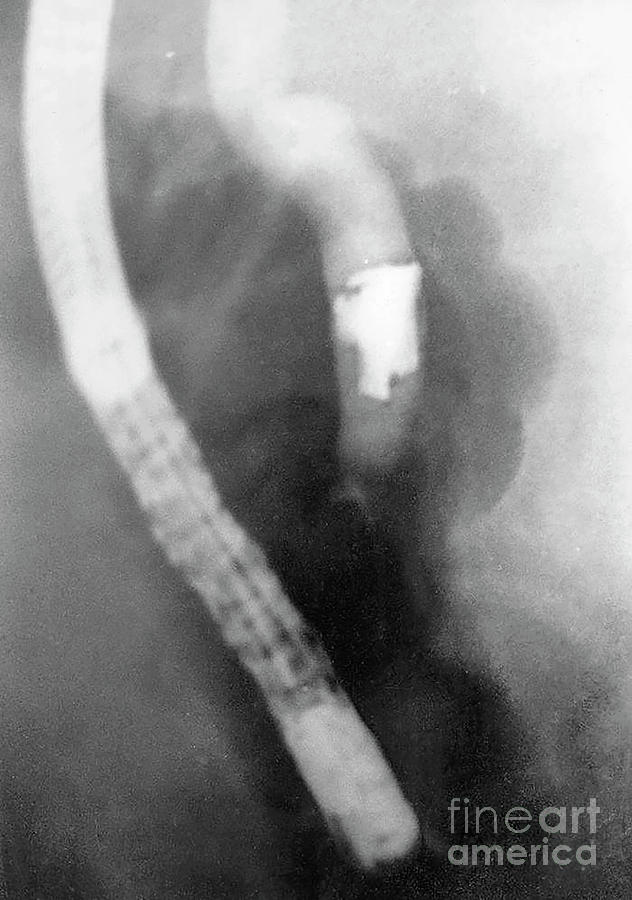 Injury Photograph - Grenade Splinter Causing Biliary Obstruction by Gastrolab/science Photo Library Injury Photograph - Grenade Splinter Causing Biliary Obstruction by Gastrolab/science Photo Library
