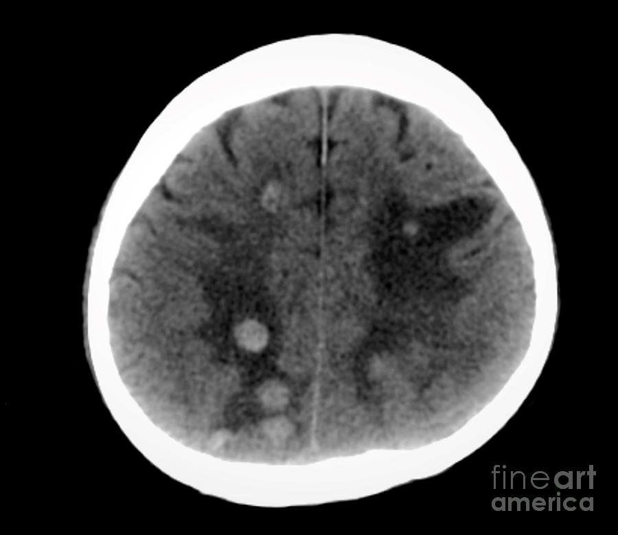 Haemorrhagic Brain Metastases by Rajaaisya/science Photo Library