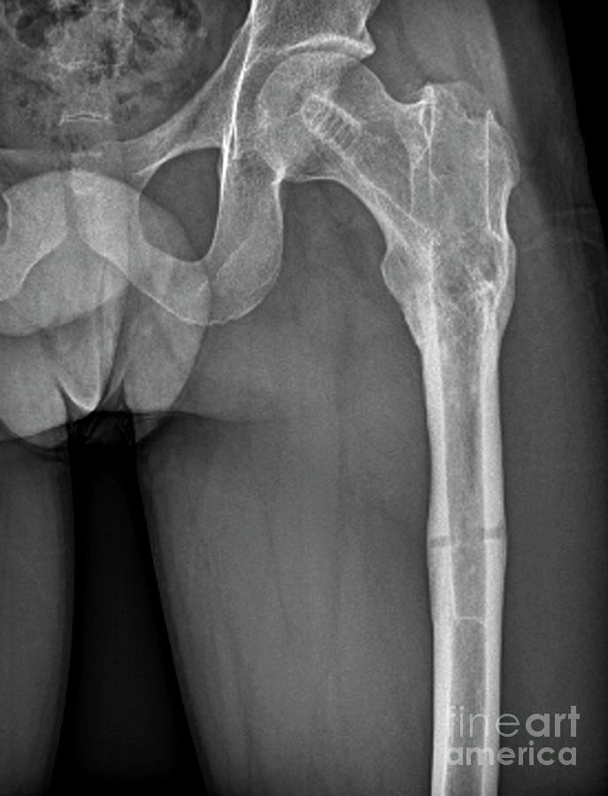 broken hip x ray