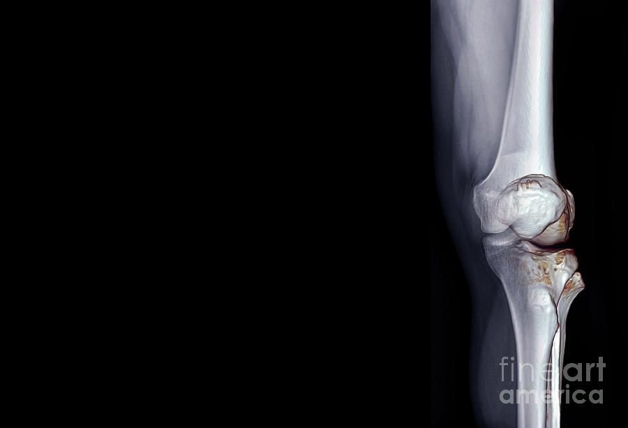 Healthy Knee Joint Photograph by Samunella/science Photo Library - Pixels