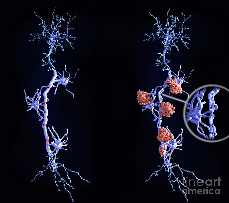 Healthy Neurons And Nerve Damage In Multiple Sclerosis Photograph by Juan Gaertner/science Photo Library