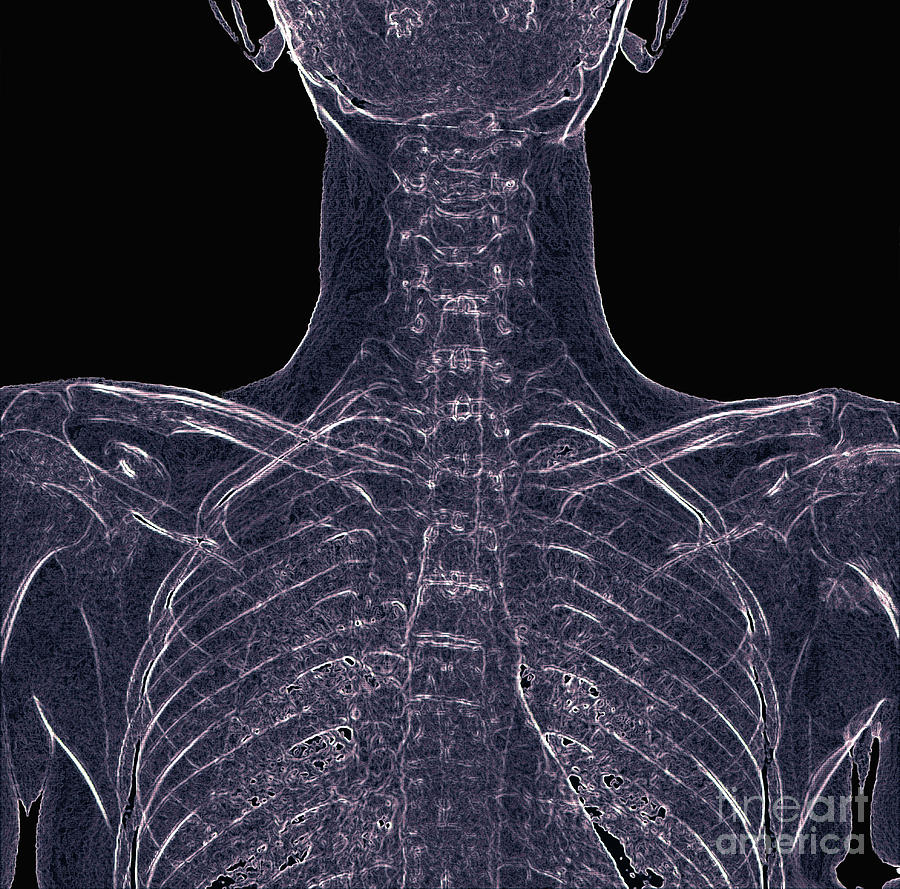 Healthy Rib Cage Photograph By Zephyrscience Photo Library Fine Art