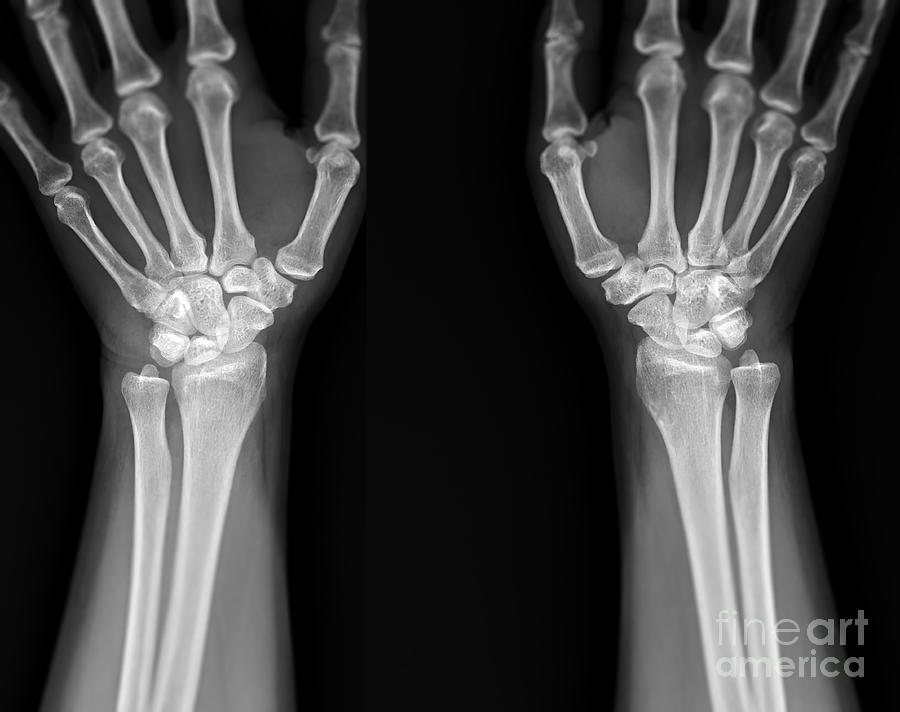 Healthy Wrists Photograph by Samunella/science Photo Library - Fine Art ...