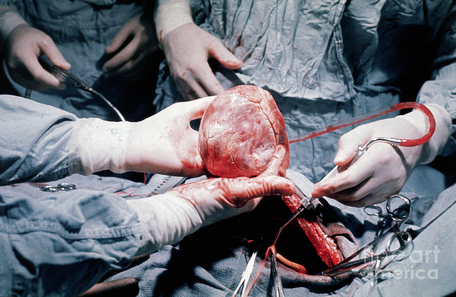 Heart Transplant Operation Photograph by Bettmann