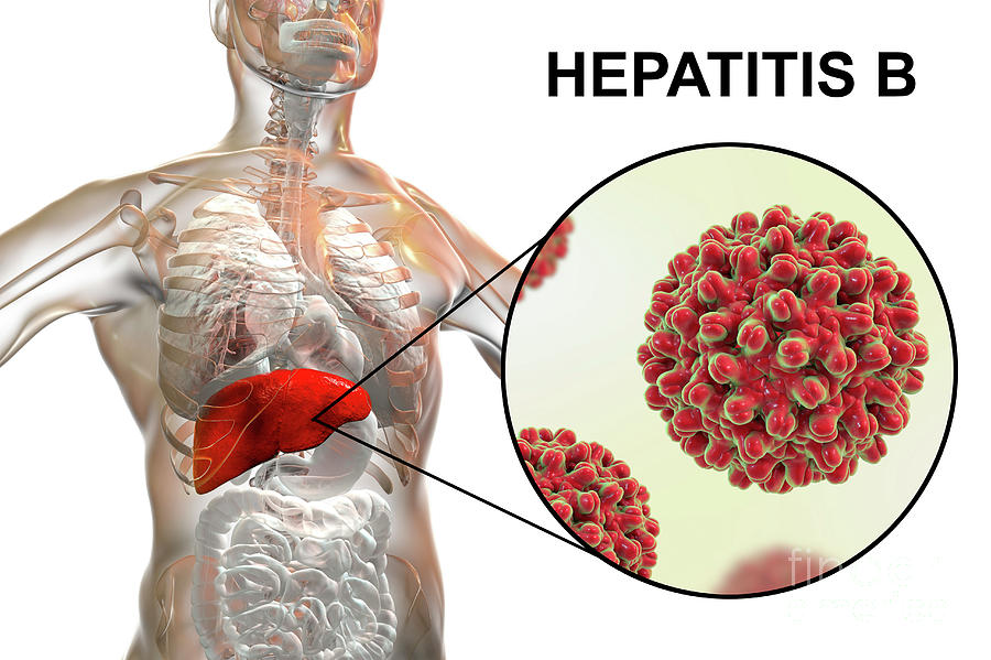 Hepatitis B Infection By Kateryna Konscience Photo Library 6036