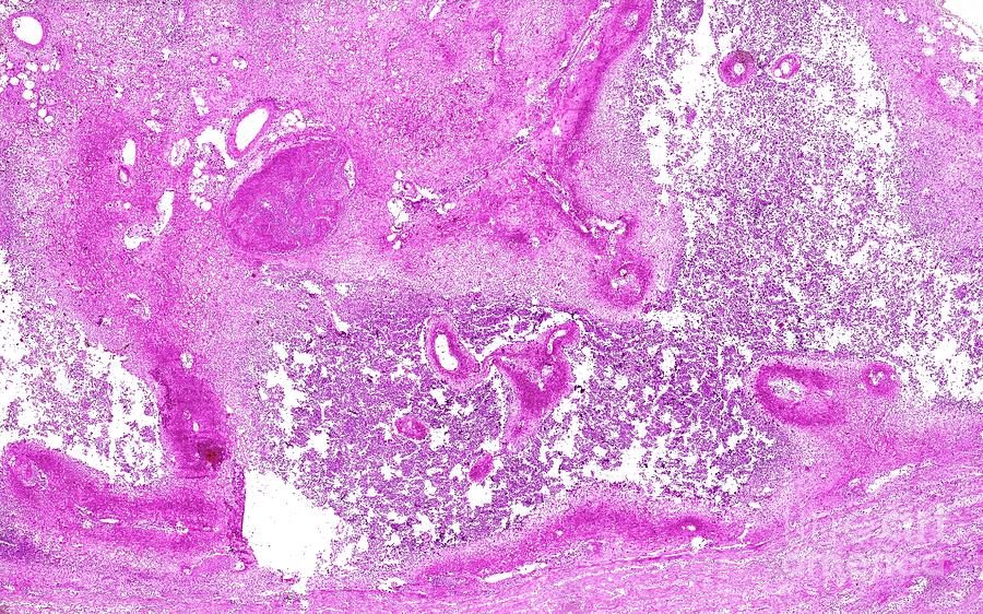 Hereditary Diffuse Gastric Cancer Photograph By Nigel Downer/science ...