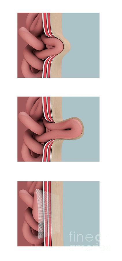 Hernia Anatomy And Repair Photograph by Mikkel Juul Jensen / Science Photo Library