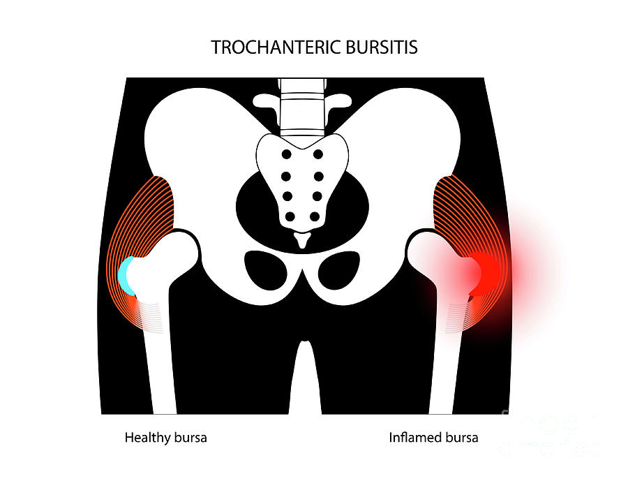 Hip Bursitis by Pikovit / Science Photo Library