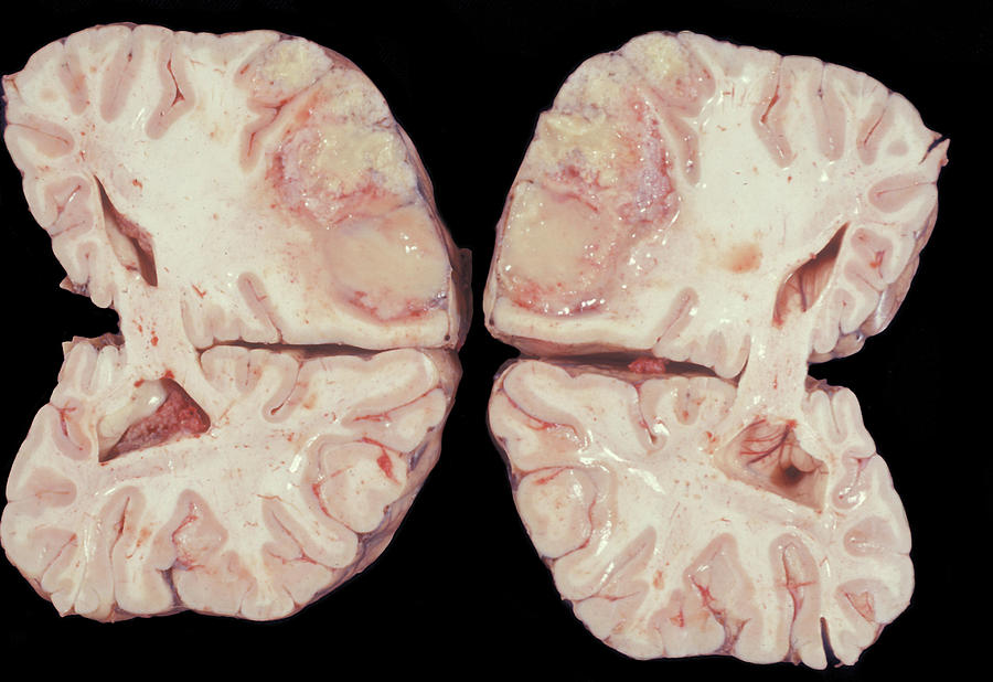 Human Brain Abscess Photograph by Jose Luis Calvo