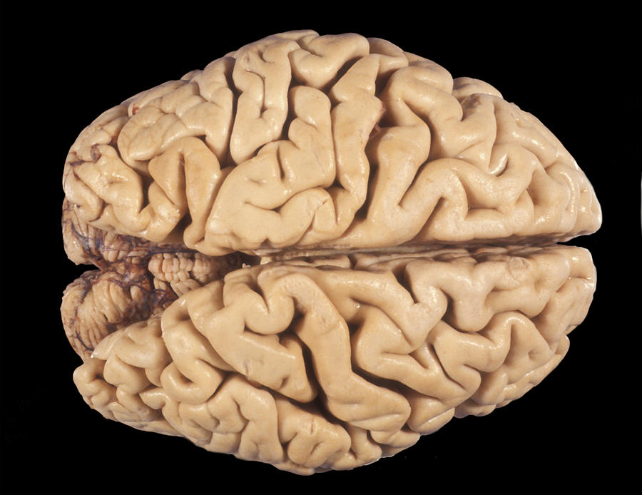 Human Brain, Atrophy Of Cerebral Cortex Photograph by Jose Luis Calvo