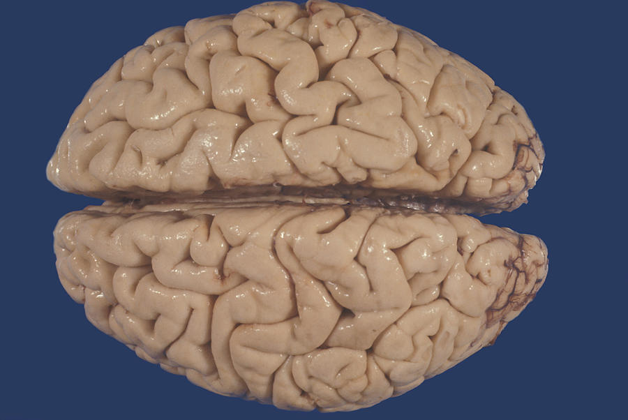 Human Brain, Cortical Atrophy Photograph by Jose Luis Calvo
