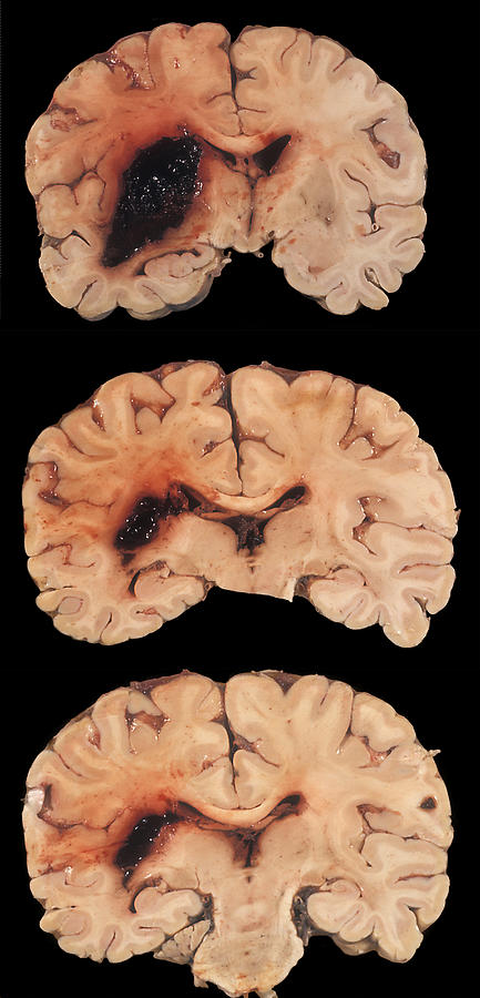 Human Brain, Hemorrhagic Infarct Photograph by Jose Luis Calvo