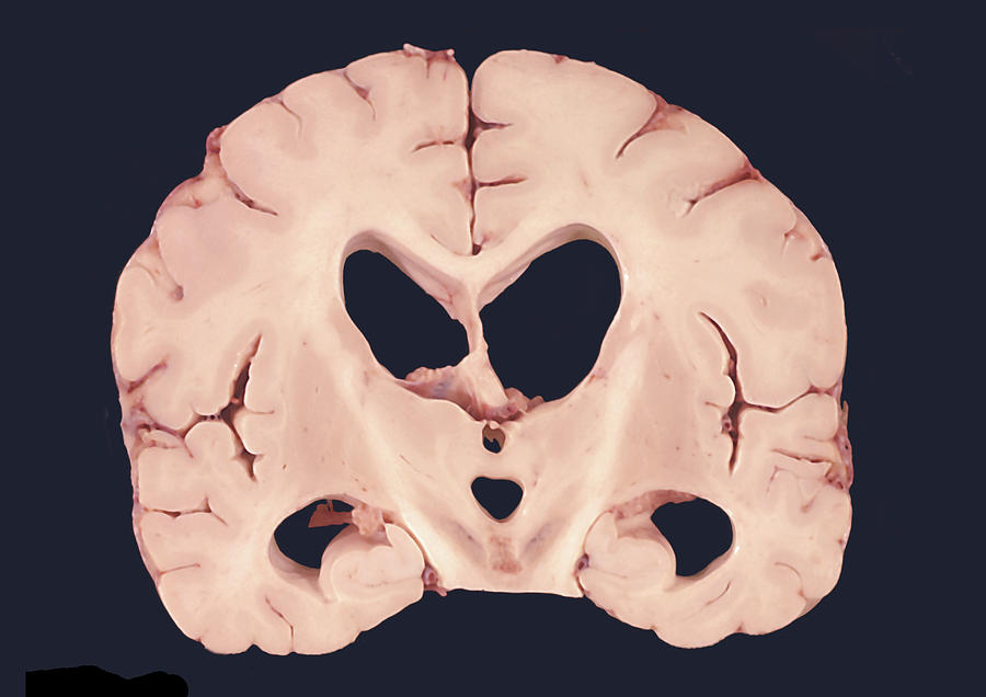 Human Brain, Hydrocephalus Photograph by Jose Luis Calvo