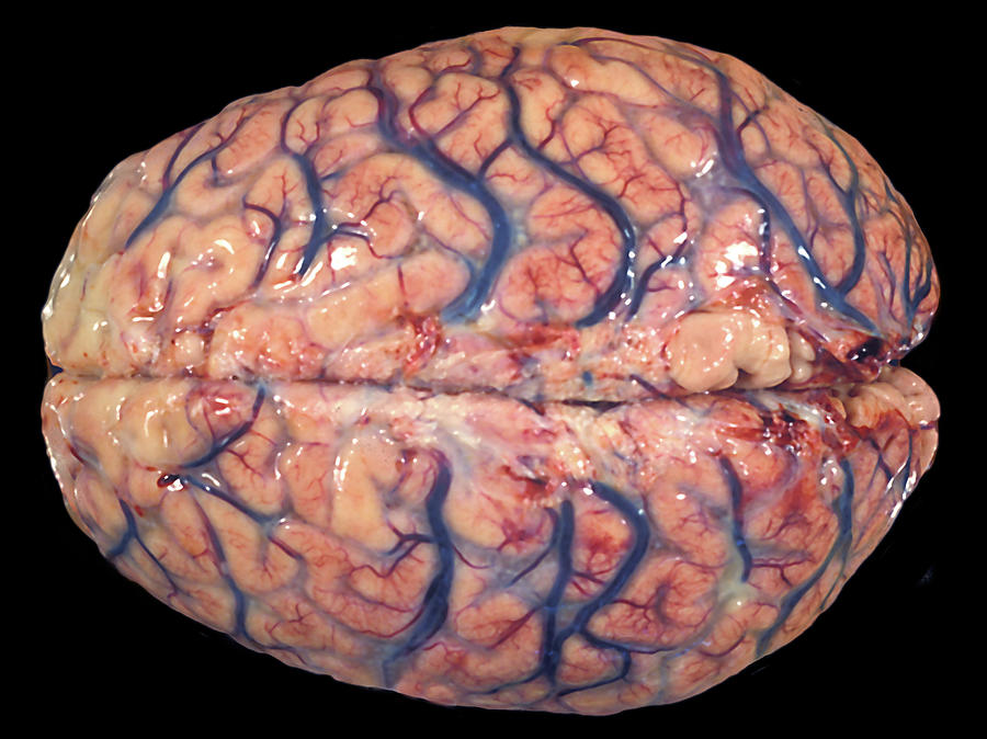 Human Brain, Meningitis Photograph by Jose Luis Calvo