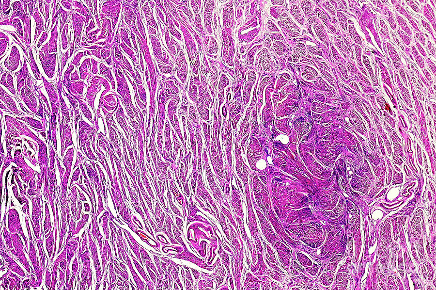 Human Cervical Ectropion Photograph By Nigel Downerscience Photo