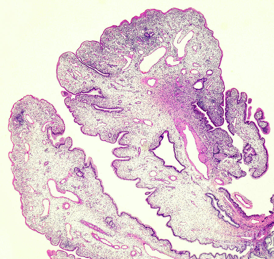 Human Cervical Polyp Photograph by Nigel Downer/science Photo Library ...