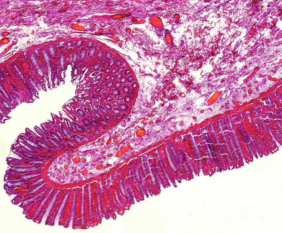 Human Colon Section Photograph by Nigel Downer/science Photo Library ...