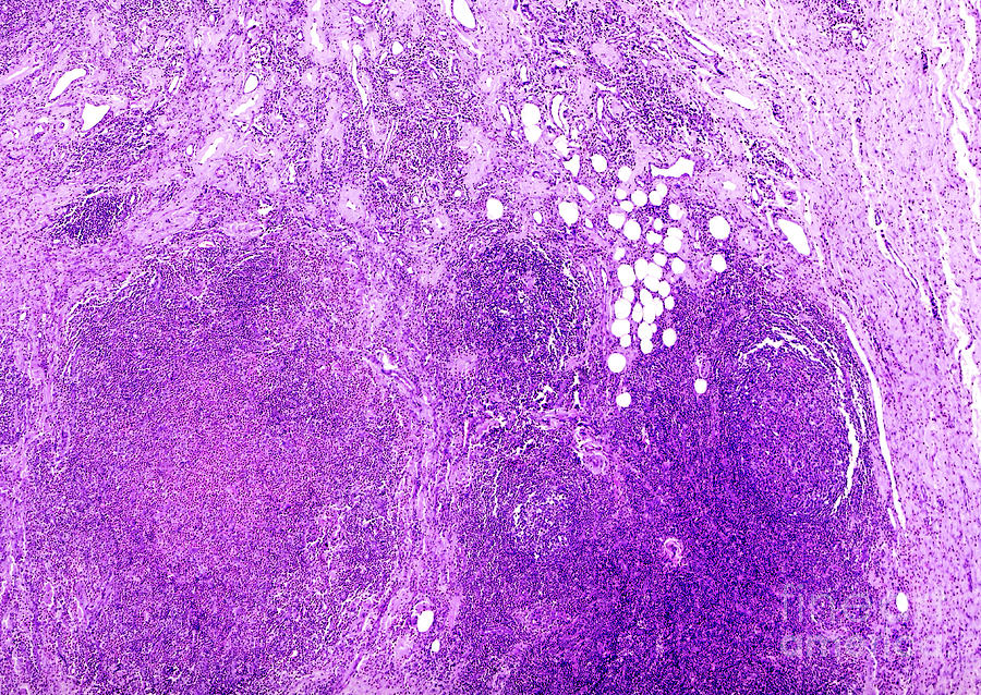 Human Eosinophilic Granuloma Photograph By Nigel Downerscience Photo