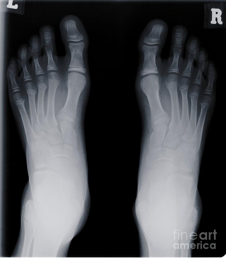 Human Feet Photograph by Nick Veasey/science Photo Library