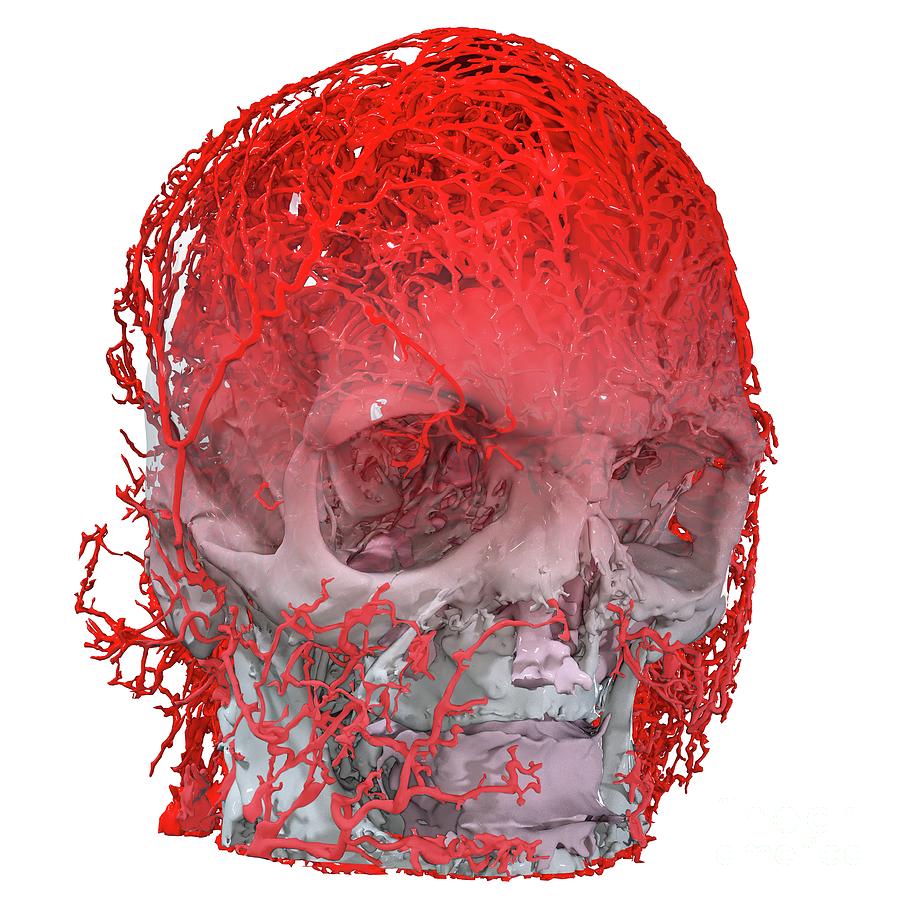 Human Head And Blood Vessels Photograph by Scott Birch/pixelbeaker/science Photo Library Pixels