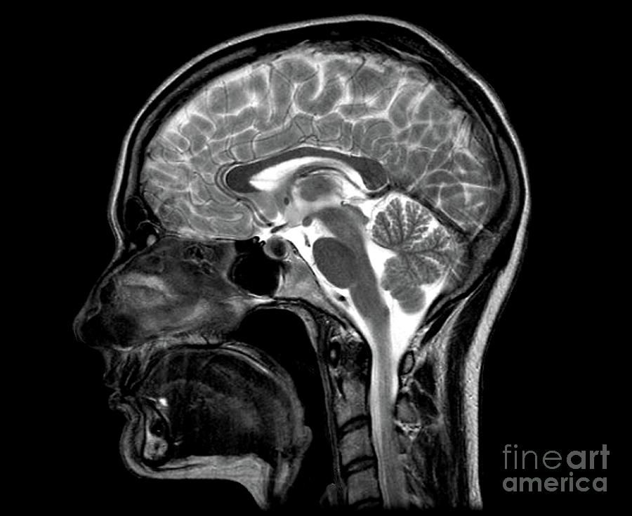 Human Head And Brain Photograph by Zephyr/science Photo Library