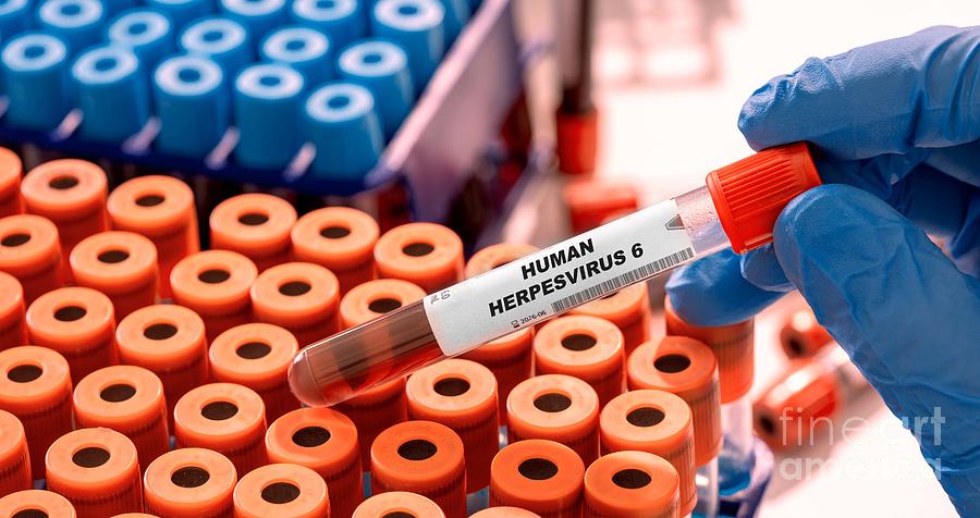 Human Herpesvirus 6 Blood Test Photograph by Wladimir Bulgar/science Photo Library