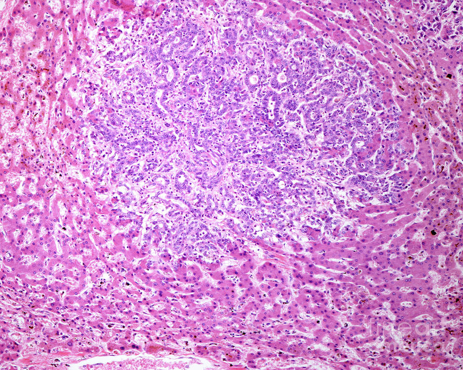 Human Liver Cholangiocarcinoma Photograph By Jose Calvo   Science Photo 