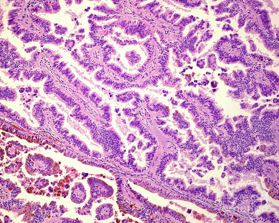 Human Renal Cell Carcinoma Photograph by Jose Calvo / Science Photo ...