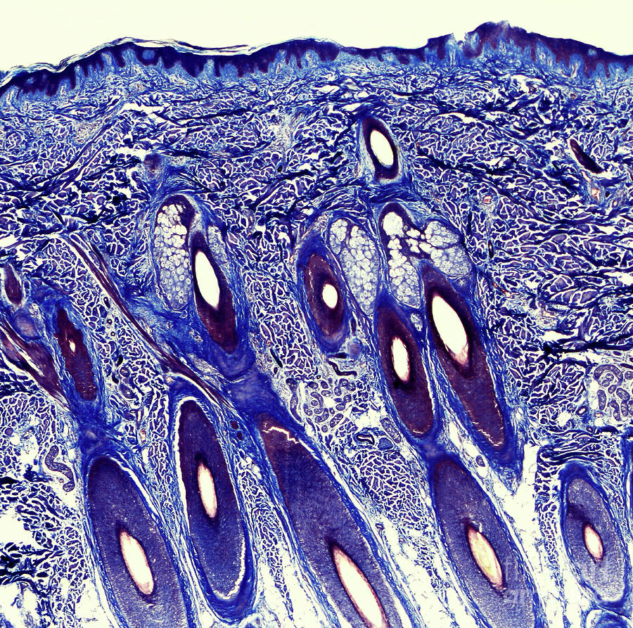  Human Scalp Photograph by Nigel Downer/science Photo Library - Fine Art ...