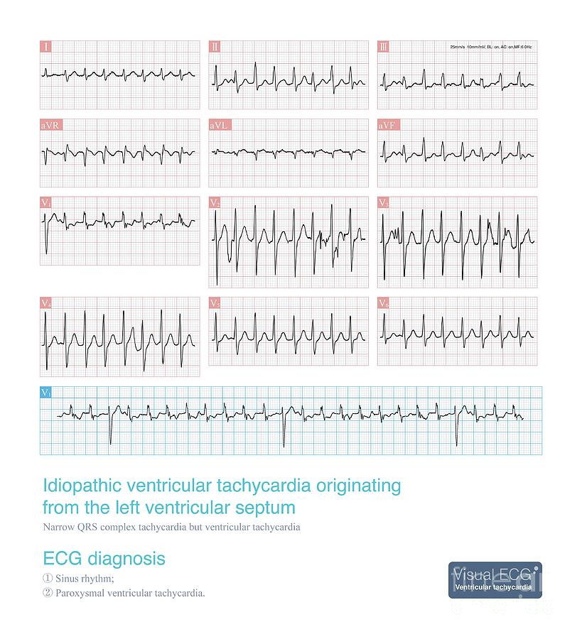 Idiopathic Ventricular Tachycardia Photograph by Chongqing Tumi ...