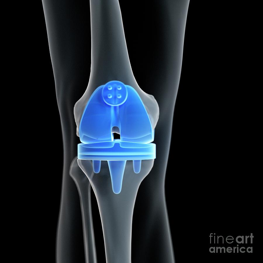 Illustration Of A Knee Replacement Photograph by Sebastian Kaulitzki ...