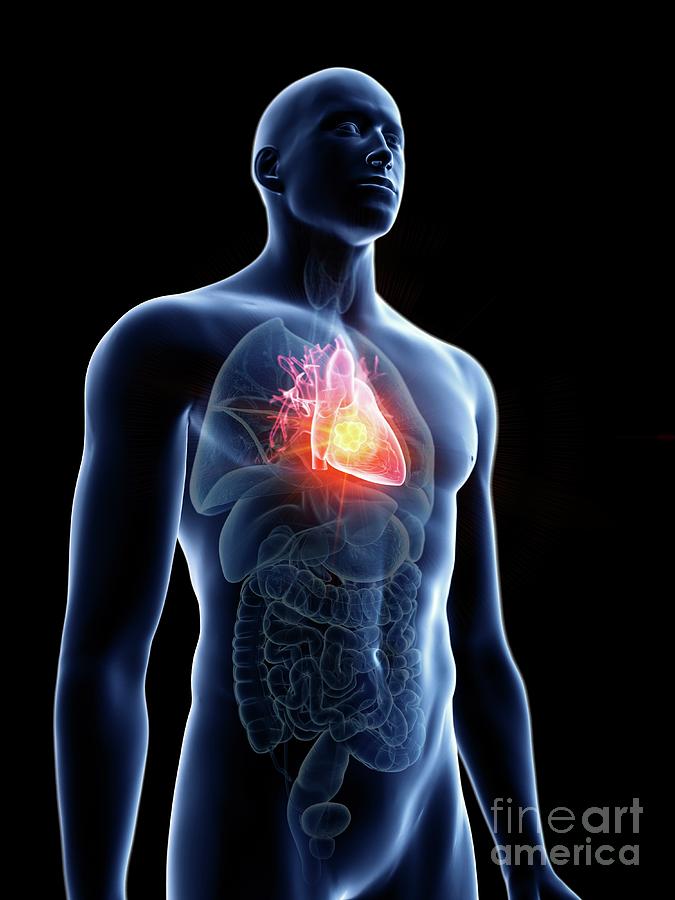 Illustration Of A Man's Heart Tumour Photograph by Sebastian Kaulitzki ...
