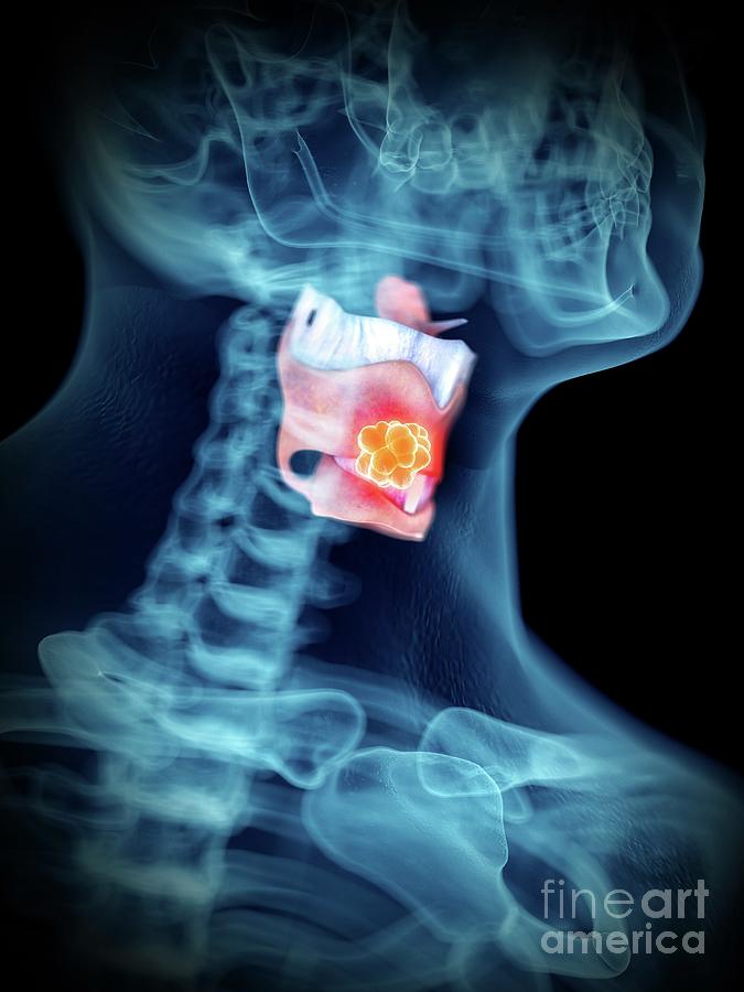 3d Photograph - Illustration Of A Mans Larynx Tumour by Sebastian Kaulitzki/science Photo Library