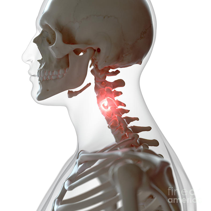 Illustration Of A Painful Cervical Spine by Sebastian Kaulitzki/science ...