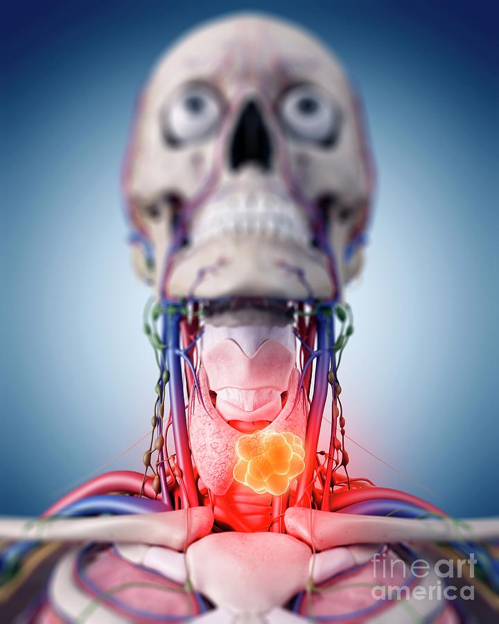 Skull Photograph - Illustration Of A Thyroid Tumour by Sebastian Kaulitzki/science Photo Library