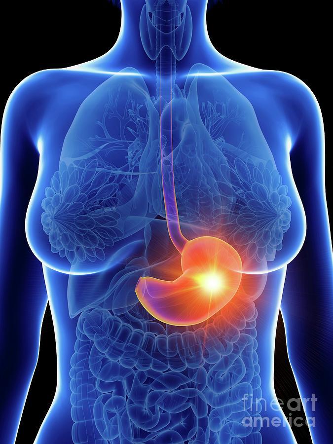Illustration Of A Womans Inflamed Stomach Photograph By Sebastian Kaulitzkiscience Photo 7665