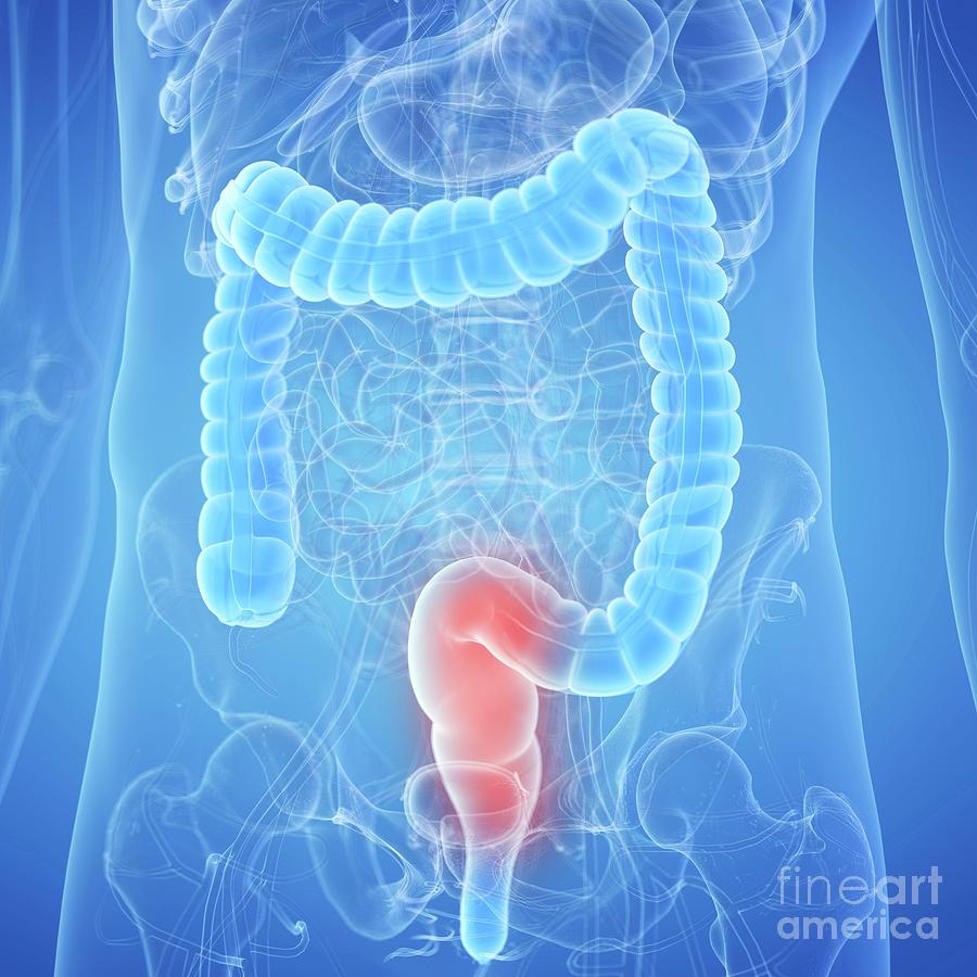 Illustration Of An Inflamed Rectum Photograph By Sebastian Kaulitzkiscience Photo Library 7338