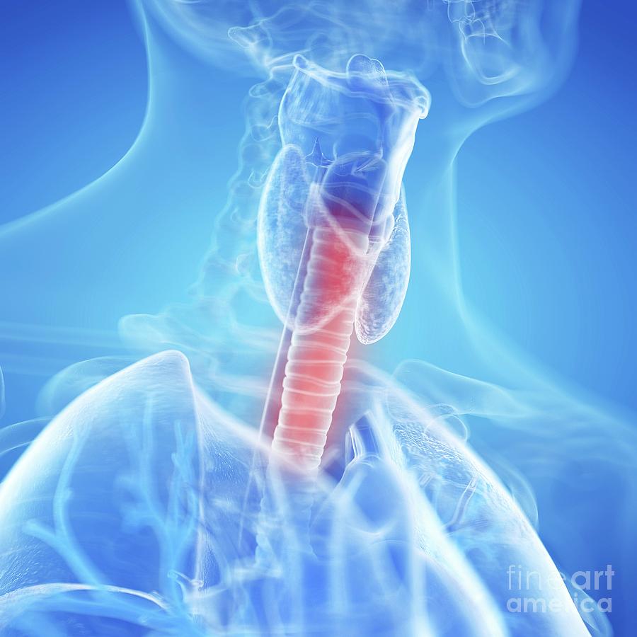 Illustration Of An Inflamed Trachea Photograph by Sebastian Kaulitzki ...