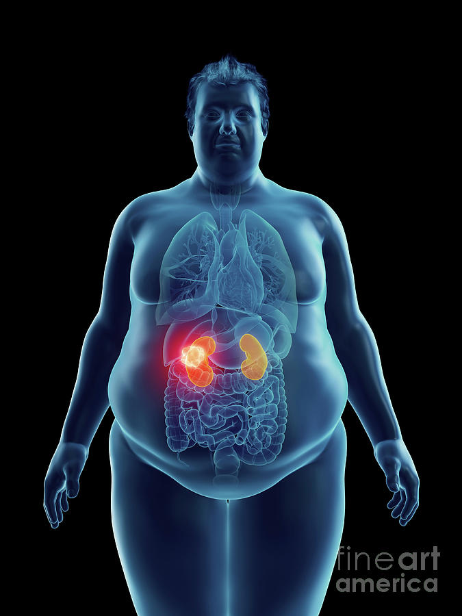 3d Photograph - Illustration Of An Obese Mans Kidney Tumor by Sebastian Kaulitzki/science Photo Library
