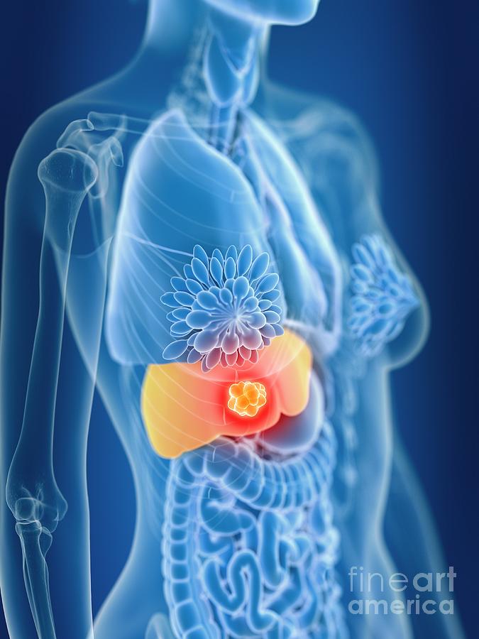Illustration Of Female Liver Cancer Photograph by Sebastian Kaulitzki