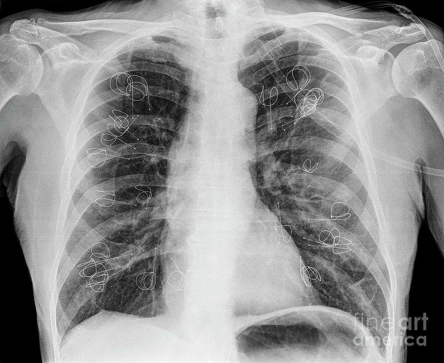 Implanted Lung Volume Reduction Coils Photograph by Science Photo Library