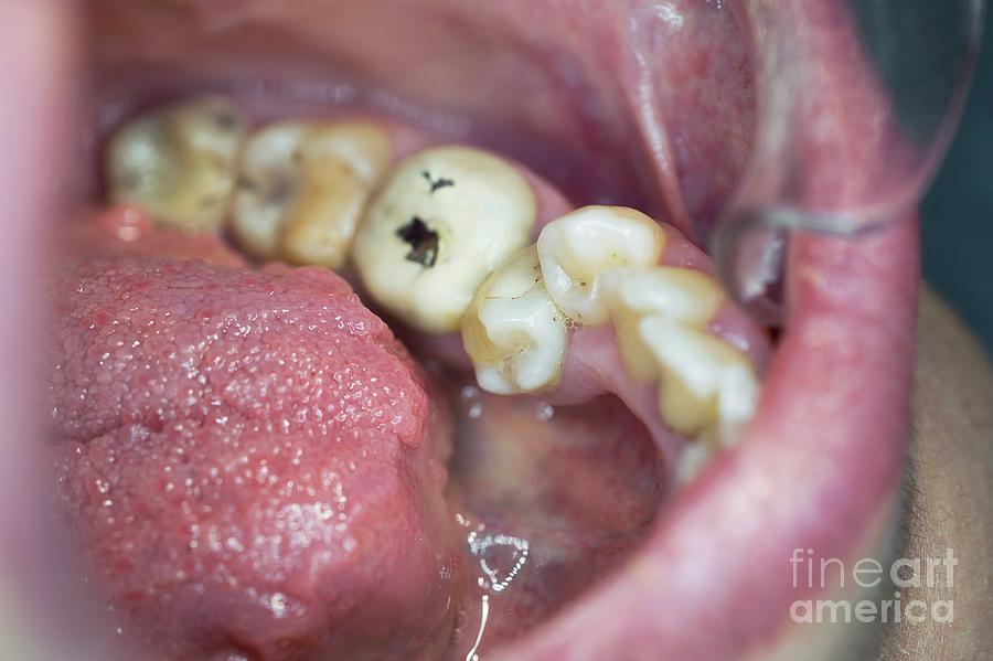 Improper Tooth Eruption Photograph By Dr Armen Taranyanscience Photo